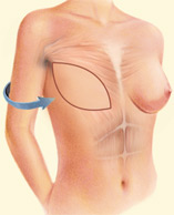 Complete Breast Mound, Muscle Delaware